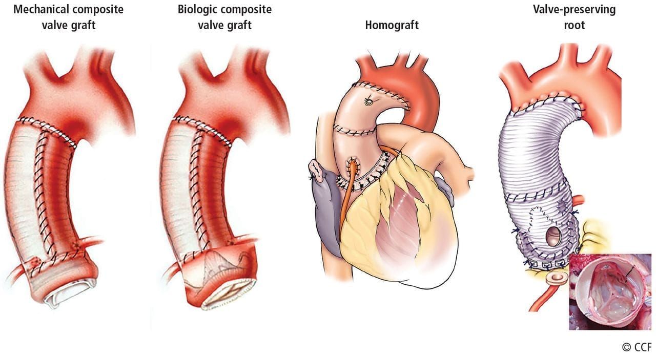 Four medical illustrations of aortic replacement techniques, labeled mechanical composite valve graft, biologic composite valve graft, homograft, and valve-preserving root.